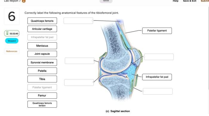 Correctly anatomical tibiofemoral