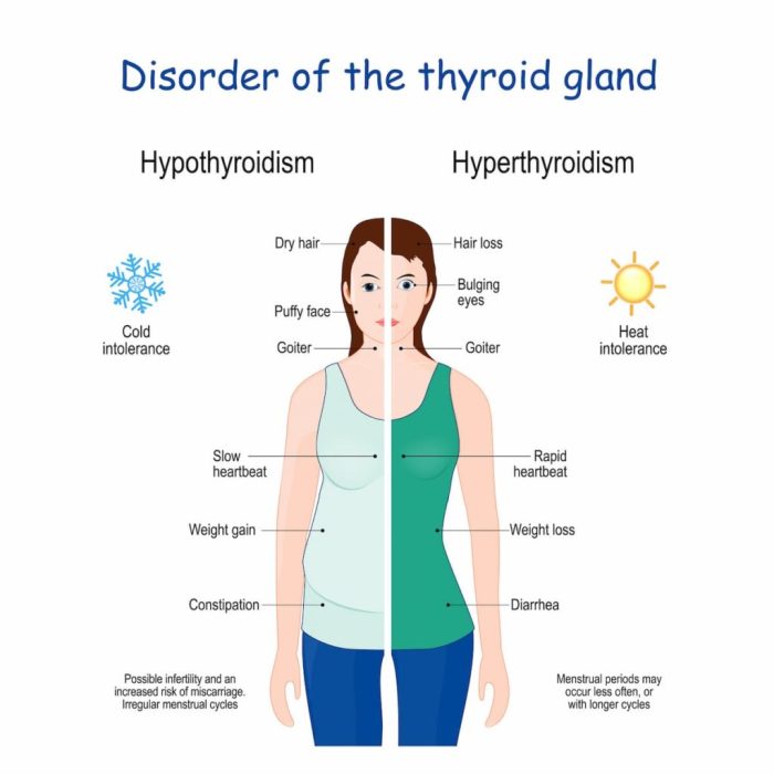 Parathyroid thyroid hyperparathyroidism glands hormones hormone osteoporosis thyroidectomy gland tiroide pth autoimmune endocrine candidiasis calcium dystrophy ectodermal paratiroidi disease humanbio